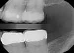 Fig 14. Radiograph of tooth No. 14 postoperative, post-cementation.