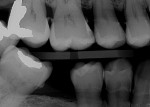Fig 3. A radiograph without AI findings. (Image courtesy of Overjet, Inc.)
