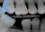 Fig 4. The same radiograph as shown in Fig 3 but with AI findings. The blue coloring indicates prior restorations. The AI detects areas suspicious for caries and outlines them in red and orange. The AI also shows bone level measurements from the cementoenamel junction to the crest of bone and quantifies the distance in millimeters. Bone levels marked in red indicate areas of elevated radiographic bone loss. (Image courtesy of Overjet, Inc.)