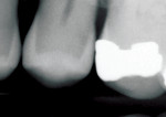 Fig 5. A radiograph without AI findings. (Image courtesy of Overjet, Inc.)