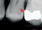 Fig 6. The same radiograph as shown in Fig 5 but with AI findings. The AI detects an area indicating a possible carious lesion on the distal of tooth No. 13. Decay was confirmed clinically and the final restoration extended into the dentin.