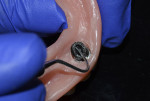 Fig 3. Locator nylon insert (black) being removed from the metal housing in the denture using an explorer instrument.