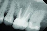 Fig 2. Preoperative radiograph of the previously restored maxillary left first molar, which was determined to be involved in a sinus perforation.