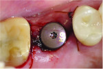 Fig 4. Postsurgical occlusal view of the tooth No. 14 site following placement of an implant and a stock healing abutment.