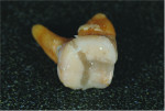 Fig 5. The extracted molar was reassembled into its original form with orthodontic wax.