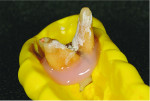 Fig 6. View of the molar placed into a matrix that was made prior to extraction. It was then lined with gingival masking material, which was trimmed to expose the contact area.