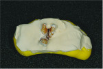 Fig 7. A cast was poured from dental stone, keeping the furcation clear.