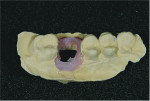 Fig 9. View of the cast after hot water was used to melt the wax and remove the molar fragments, showing the impression of the cervical area captured by the gingival masking material.