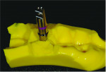 Fig 10. After the patient’s stock healing abutment was removed, an impression post was inserted into the implant, and an impression was made. Once set, an implant analog was attached to an impression post and inserted into the impression.