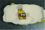 Fig 12. Top view of the space surrounding the implant analog.