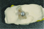 Fig 13. The gap between the implant analog and the cast was sealed with orthodontic wax before a second pour of dental stone was added to embed the implant analog in the cast.