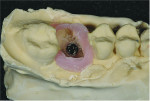 Fig 14. Occlusal view of the wax-surrounded implant analog embedded in the cast.