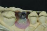 Fig 15. A temporary abutment was screwed into the implant and a bis-acryl composite resin was injected around it to fill the gap up to the gingival margin.