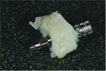 Fig 16. View of the custom healing abutment before trimming. Note how the resin flowed to the base of the abutment.