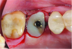 Fig 19. Occlusal view of the screw-retained custom healing abutment in place before the access was sealed.