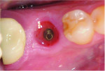 Fig 22. Example of a healed implant site obtained with a stock healing abutment. Note the less-than-anatomic dimensions when compared with the site obtained by the custom healing abutment in Figure 21.