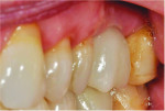 Fig 23. Posttreatment photograph of the definitive restoration 30 months after insertion demonstrating a natural emergence profile.