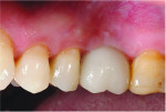 Fig 24. Posttreatment photograph of the definitive restoration 30 months after insertion demonstrating gingival margins and papillae in harmony with those of the surrounding dentition.