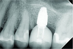 Fig 25. Posttreatment radiograph of the definitive restoration 30 months after insertion demonstrating preservation of the hard and soft tissues.