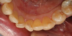Pretreatment and posttreatment mandibular anterior occlusal views of an 87-year-old male patient whose mandibular central incisors were treated for the effects of wear with minimally invasive composite restorations.