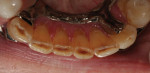 Pretreatment mandibular anterior occlusal view of an 82-year-old female patient demonstrating severe wear of the edges of her incisors and right canine.
