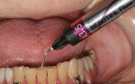 The teeth were conservatively prepared without anesthesia, and then a bioactive nanohybrid flowable composite was placed.