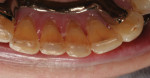 Posttreatment occlusal views of the completed minimally invasive composite restorations after finishing and polishing.