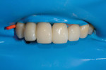 After the teeth were ensconced with composite using an injection over-molding technique, they were rapidly sculpted and then polished using a two-step system to create margin-free and stain resistant surfaces.
