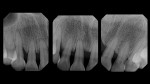 Comparison of the preoperative and postoperative radiographs demonstrating an aggressive yet healthy and precise change in contour.