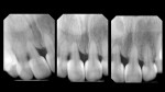 Comparison of the preoperative and postoperative radiographs demonstrating an aggressive yet healthy and precise change in contour.