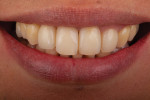 Two-year follow-up smile photograph and full face patient portrait demonstrating both the stain resistance of the restorations and the stability of the restoratively driven papilla regeneration. Note how the patient’s confidence results in a more relaxed and natural smile.