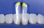 Due to the shape of the patient’s teeth, the small yellow matrices were selected instead of the less curvaceous pink matrices indicated by the gauge. The gauge is an excellent starting point for matrix selection, but clinical try-in of the matrices is the ultimate indicator.