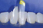 After the first tooth (No. 25) was injection molded, the matrix was removed to ensure a tight contact before tooth No. 24 was injection molded. Note the plastic-like finish.
