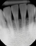 A comparison of the preoperative and postoperative radiographs demonstrates the marginal integrity and the lack of voids.