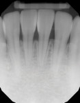 A comparison of the preoperative and postoperative radiographs demonstrates the marginal integrity and the lack of voids.