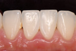 Two-year postoperative view of the completed restorations demonstrating an excellent soft-tissue response. Note the lack of calculus buildup in the treated embrasure between teeth Nos. 24 and 25 when compared with the calculus in the untreated embrasure between teeth Nos. 25 and 26.